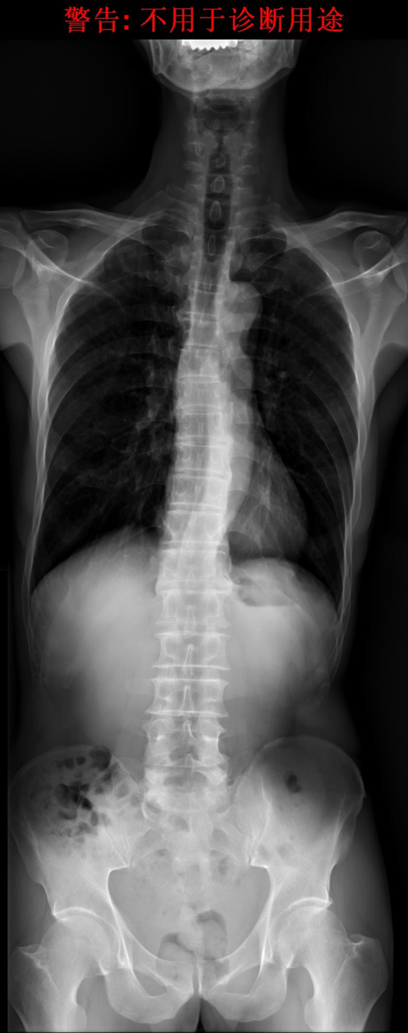 Research on the Existence of Chinese Loadbearing bow of Spine Report