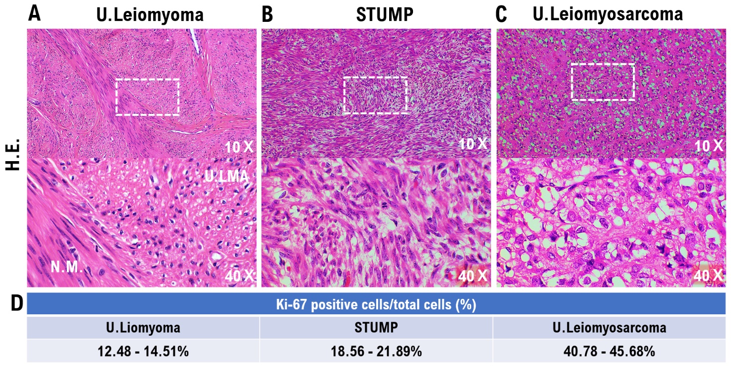 Challenges in identifying biomarkers for Smooth muscle tumors of